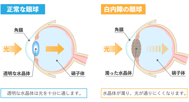 白内障イメージ