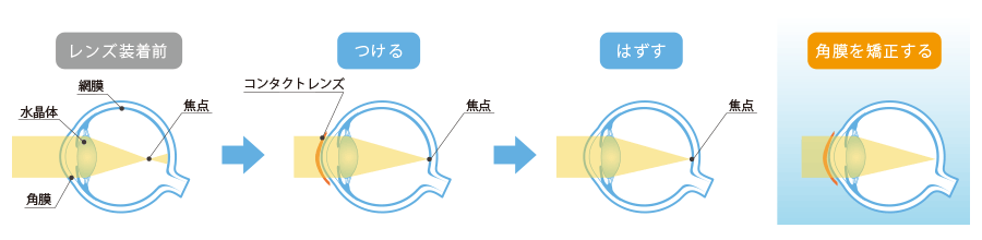 オルソケラトロジーの視力矯正方法