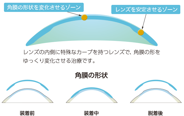 オルソケラトロジー治療に使用するレンズの仕組みについて説明した画像です。